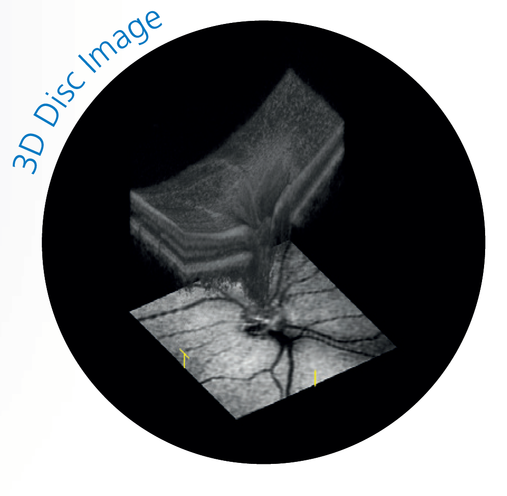 3D OCT scan of the optic disc for glaucoma screening