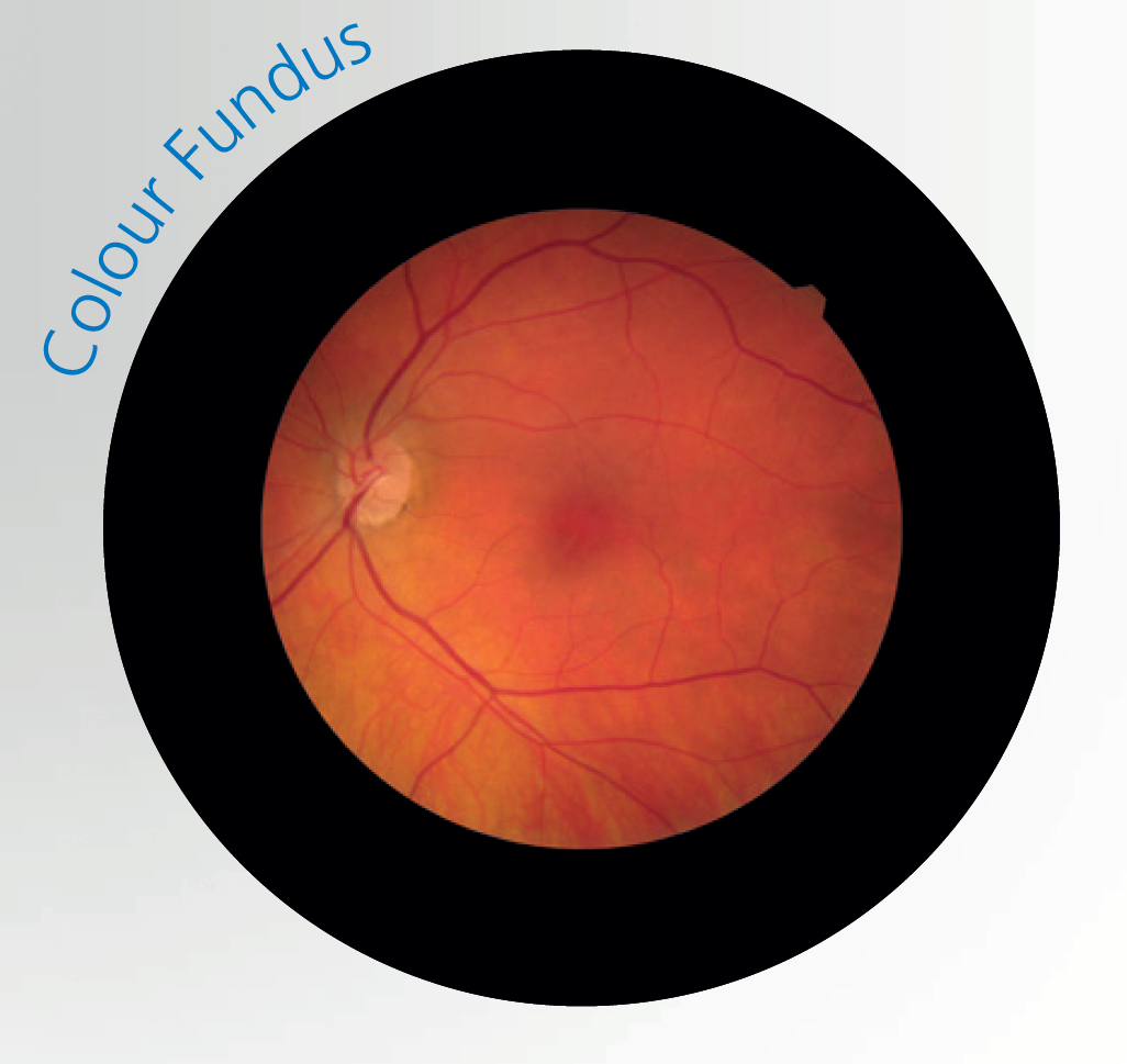Colour fundus photograph of the retina