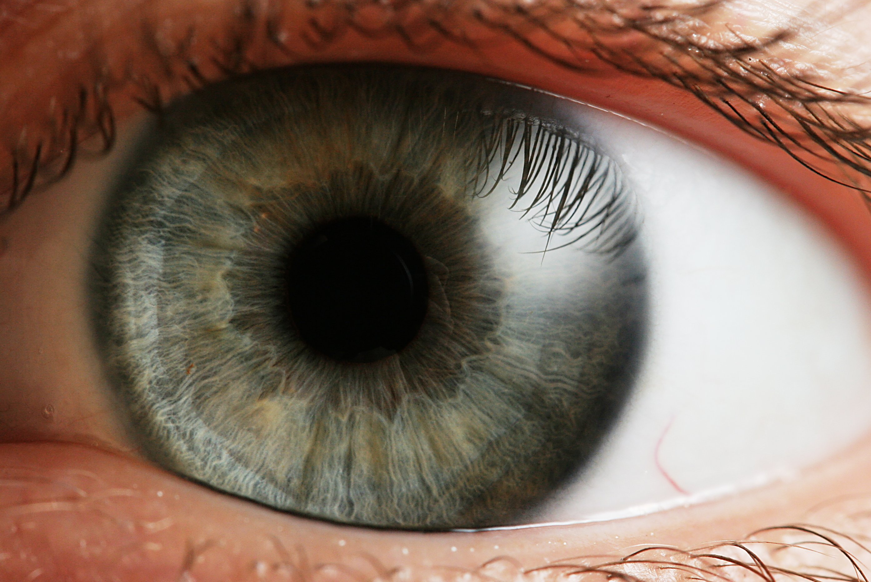 Close-up eye examination for blepharitis assessment at Family Eyecare
