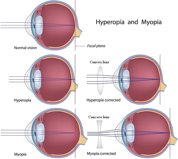 Animated diagram showing the difference between hyperopia and myopia in the eye